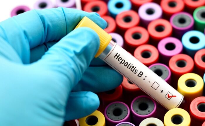 Hepatitis B